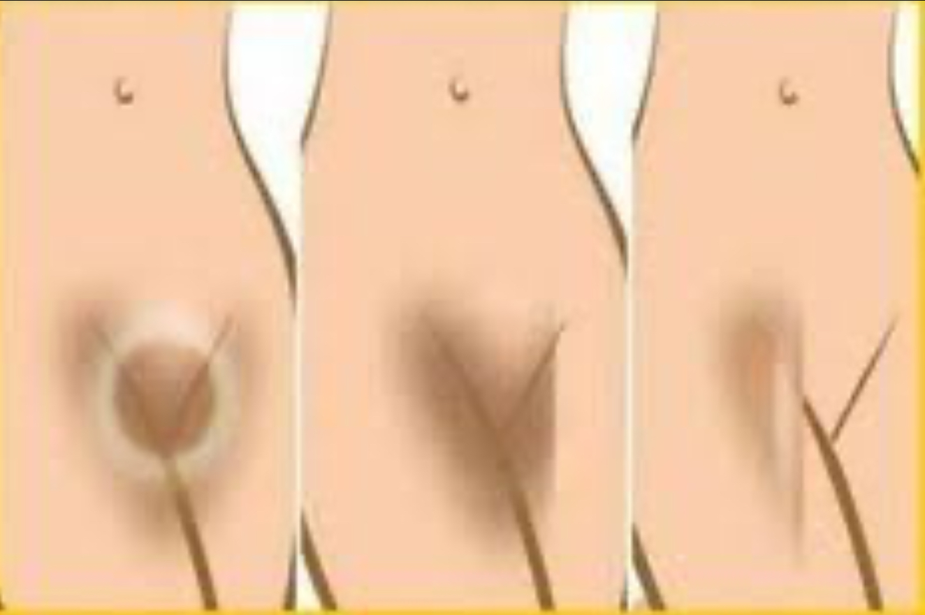 Natural Remedies For Hyperpigmentation Around The Pubic Area