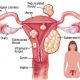 fibroid