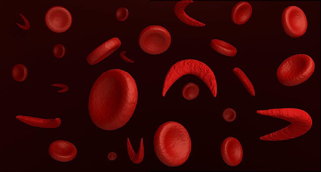 Sickle Cell Disease