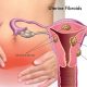 uterine fibroids surgery
