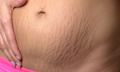 pregnancy healthy skin stretch marks