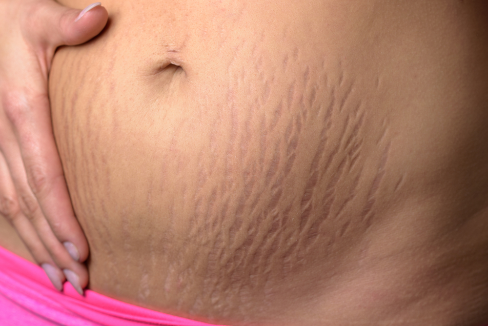 pregnancy healthy skin stretch marks