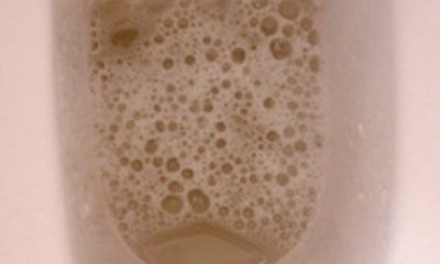 Foamy Urine kidney