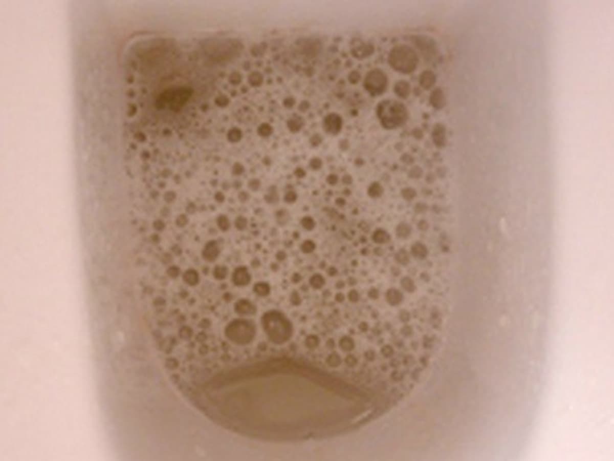 Foamy Urine kidney