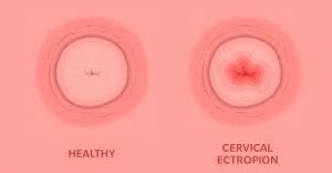 Ectropion