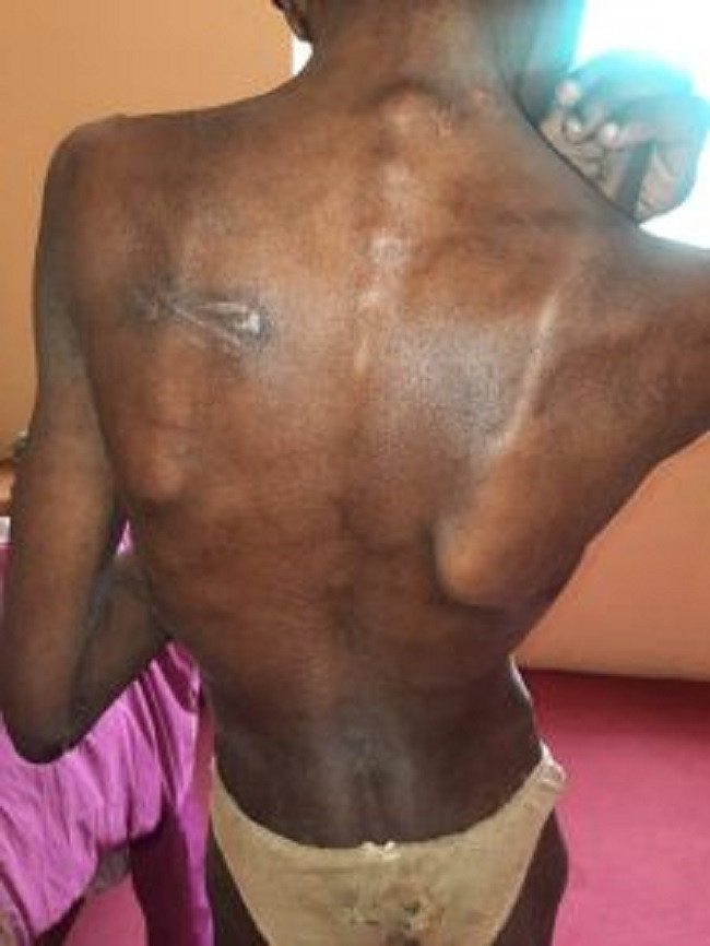 Malnourished girl in Jos