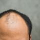 Baldness