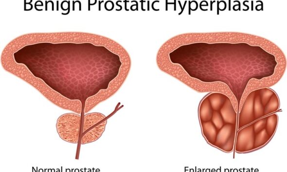 prostate