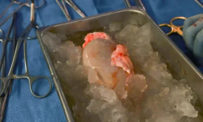 pig kidney transplant
