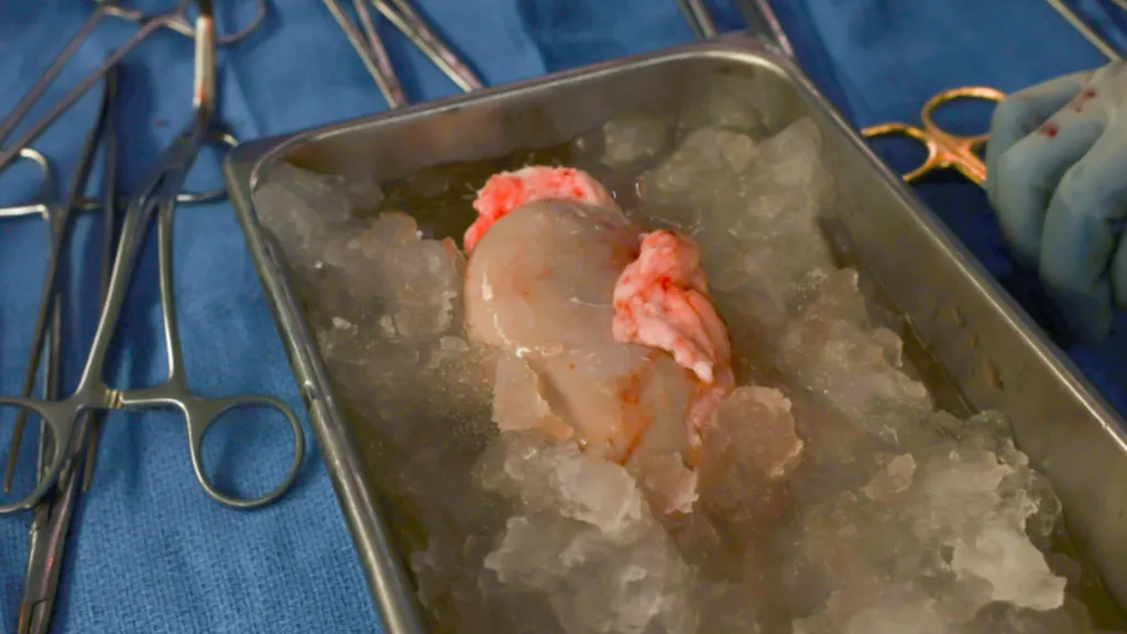 pig kidney transplant