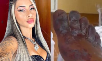 Feet of Mc Thammy burns after partaking in Ill-advised online challenge