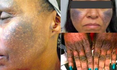 Five downsides of skin bleaching