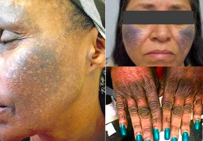 Five downsides of skin bleaching