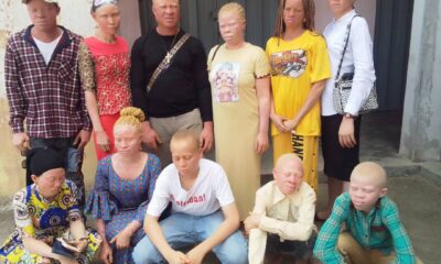 Albinism Ondo