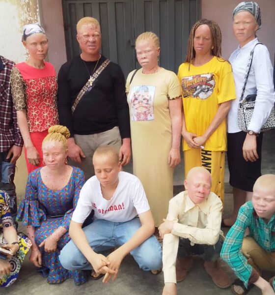 Albinism Ondo