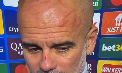 Pep Guardiola cuts nose after draw