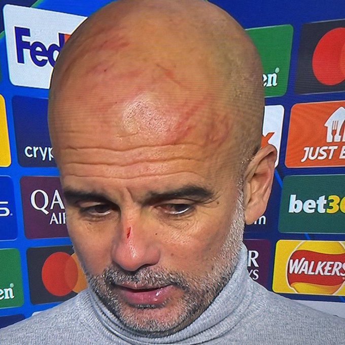 Pep Guardiola cuts nose after draw